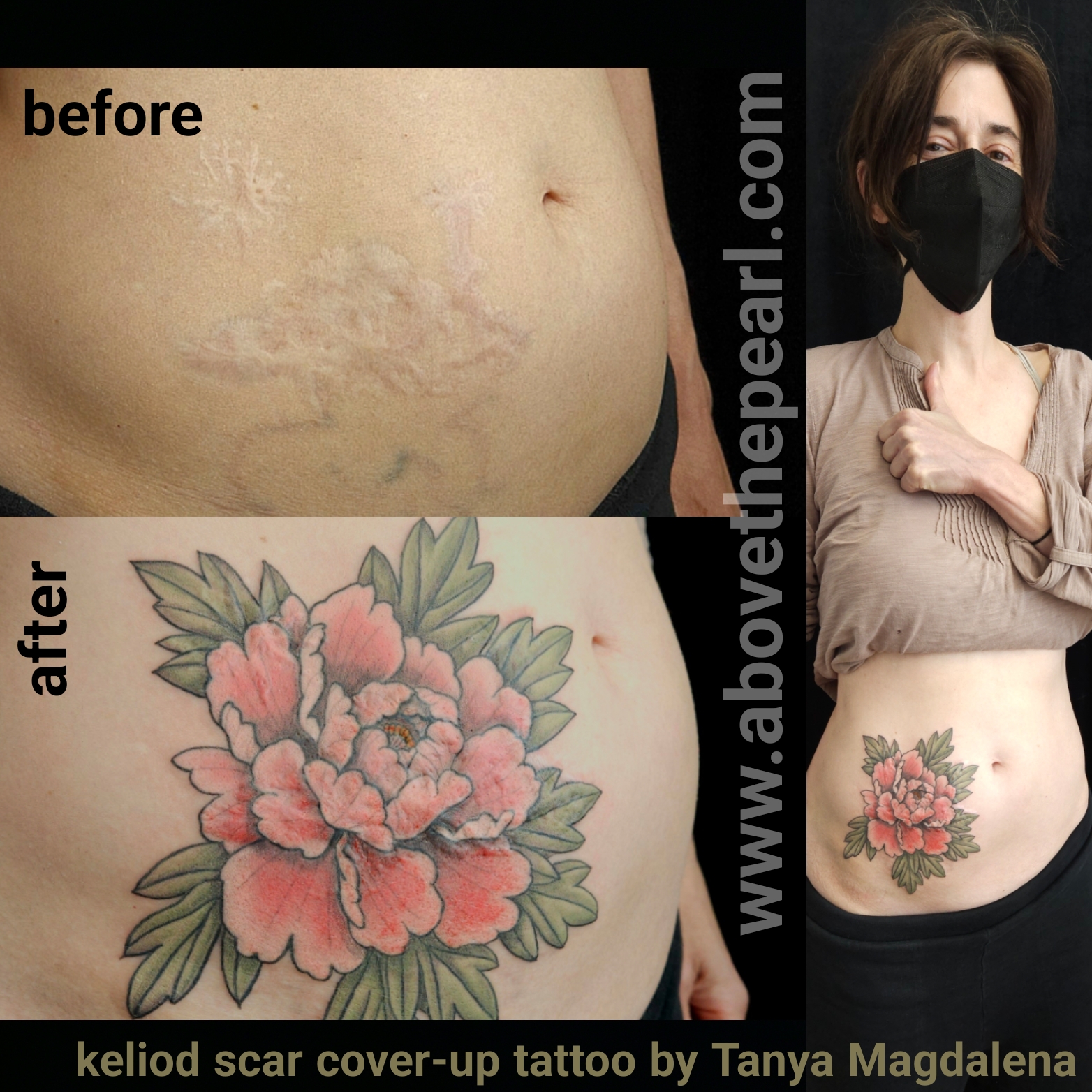 tattoo removal scar cover-up by Tanya Magdalena